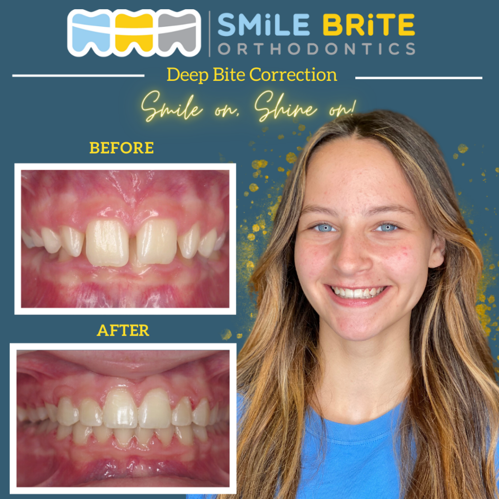 Smile Brite Orthodontics - Deep bite correction