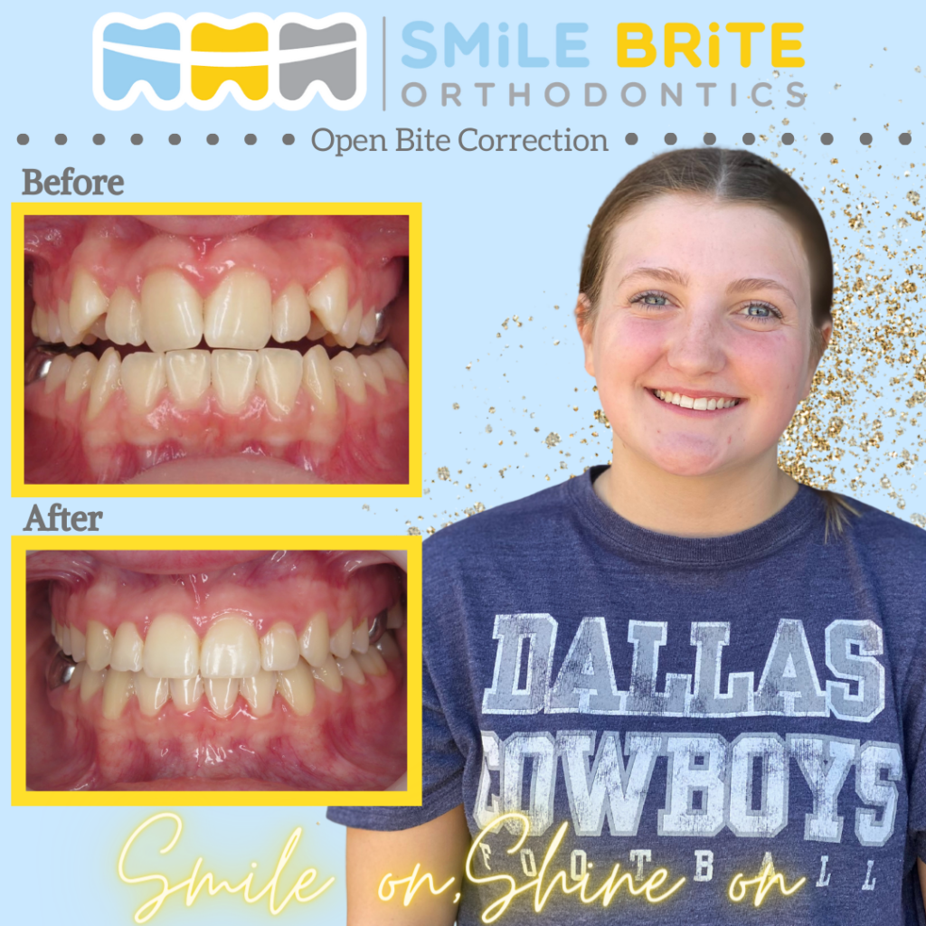 Smile Brite Orthodontics - Open bite correction