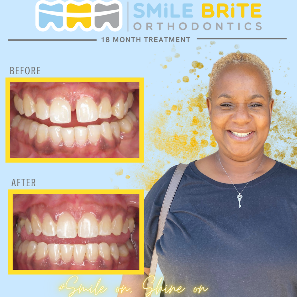 Smile Brite Orthodontics - 18 month treatment