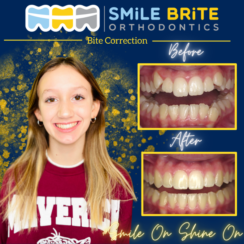 Smile Brite Orthodontics - Bite Correction
