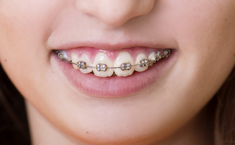 braces