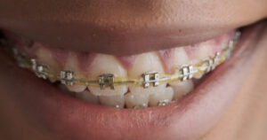 braces