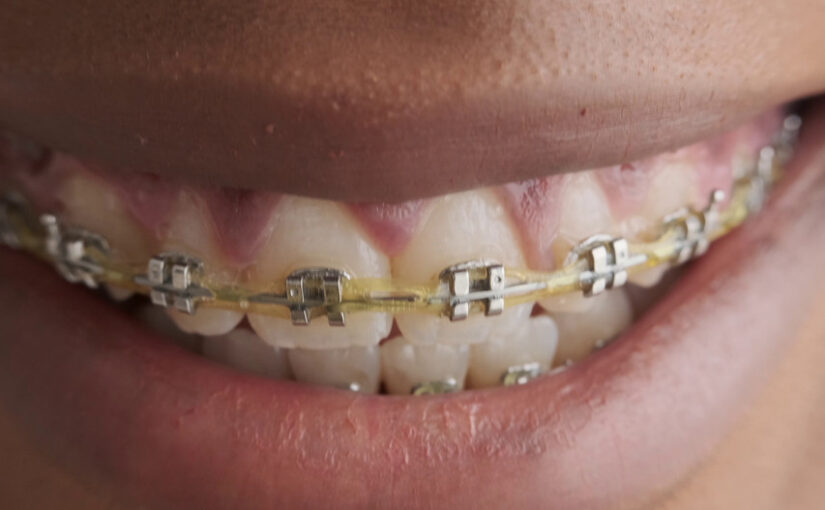 braces