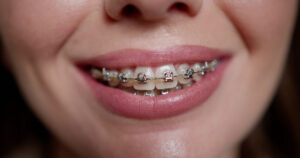 same day braces