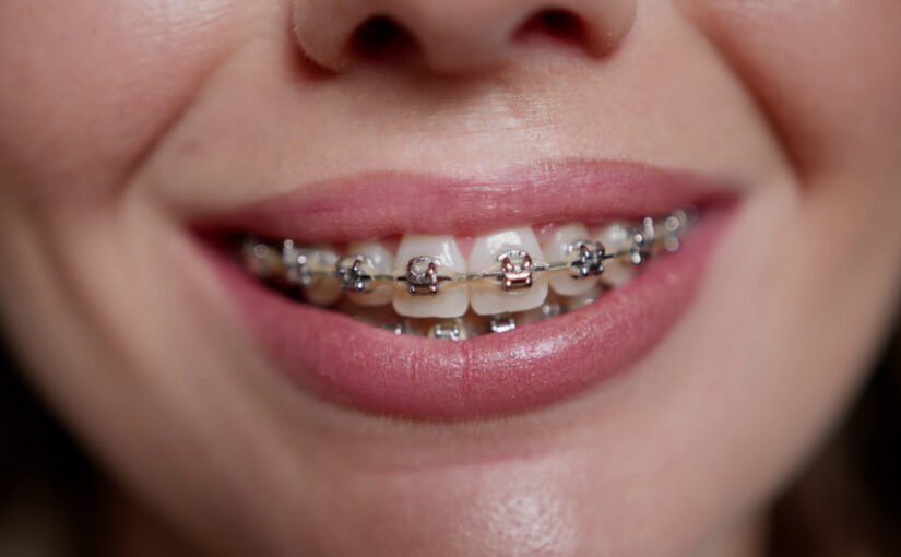 same day braces
