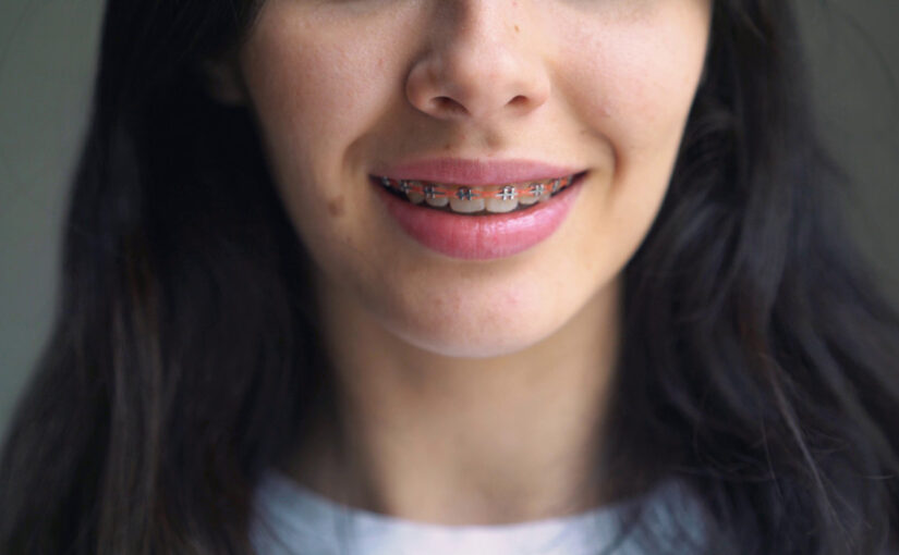 traditional metal braces
