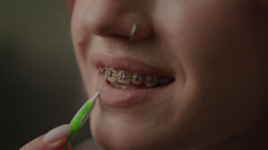 traditional metal braces