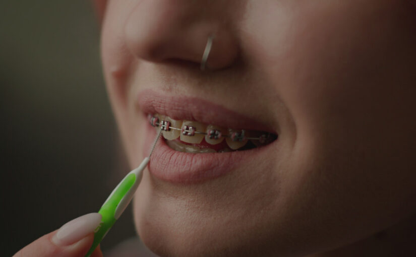 traditional metal braces