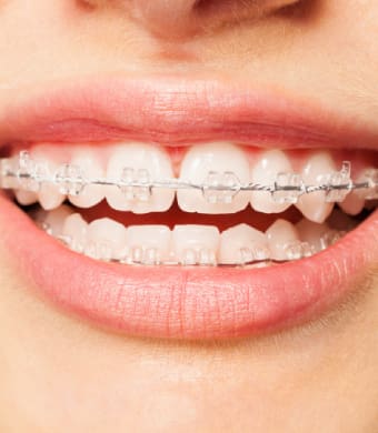 Ceramic Braces