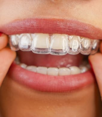 Clear Aligners