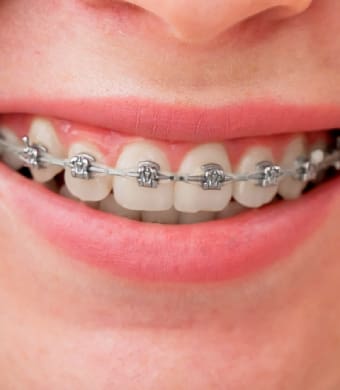 Traditional Braces